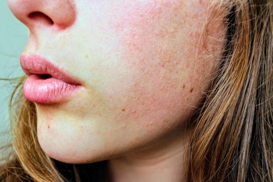 How to fix a damaged skin barrier